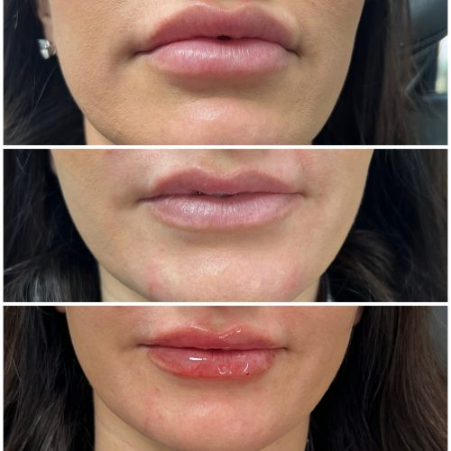 Hylenex - Before, Immediately After and 2 wks After