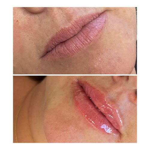 Redensity Before & After | Medical Spa Southlake TX | The Aesthetics Society