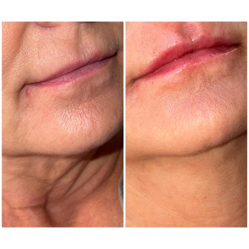 Redensity Before & After |Medical Spa Southlake TX | The Aesthetics Society