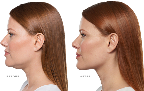 What is KYBELLA® KYBELLA®